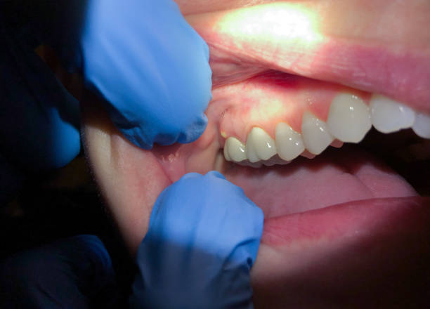 Best Emergency Dental Care for Abscessed Tooth in Orangeburg, SC